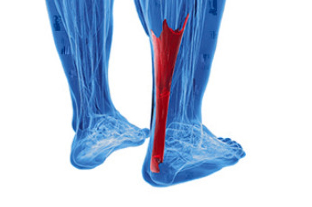 Signs of an Achilles Tendon Injury