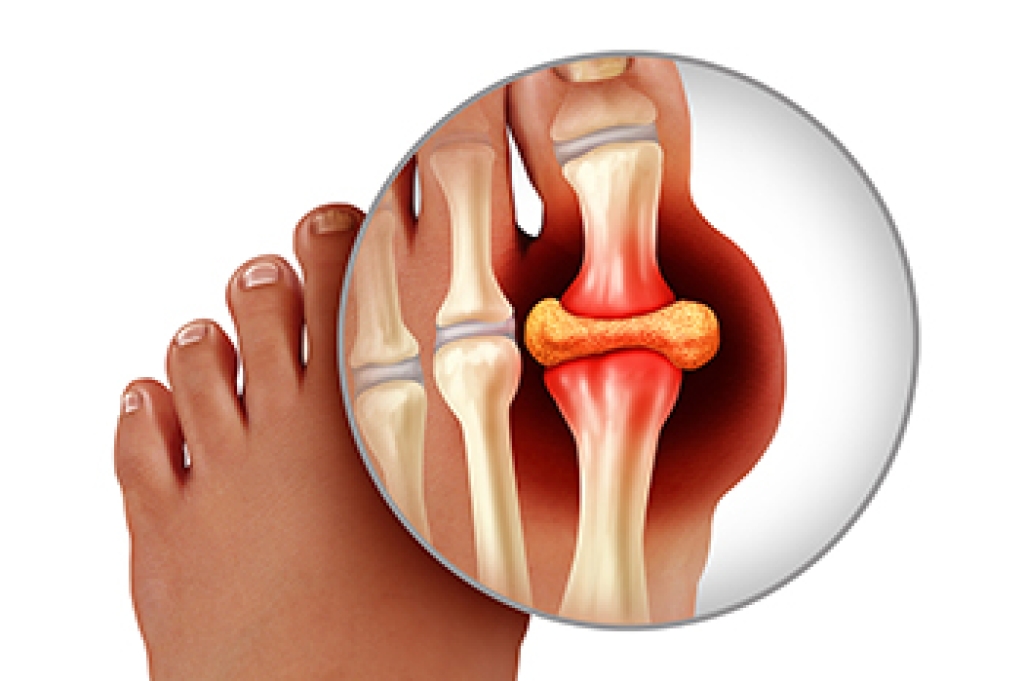 Gout and Sudden Big Toe Pain