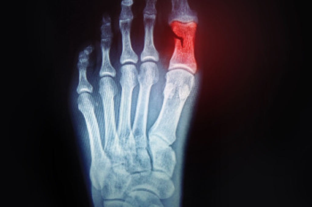 Broken Toe Pain in Runners