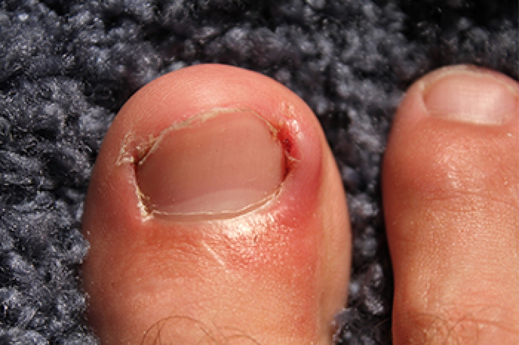 Why Toe Skin Can Mimic an Ingrown Toenail