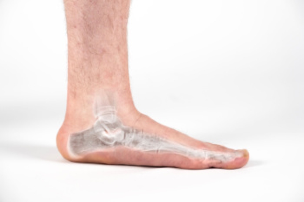 Foot Problems Caused by Flat Feet
