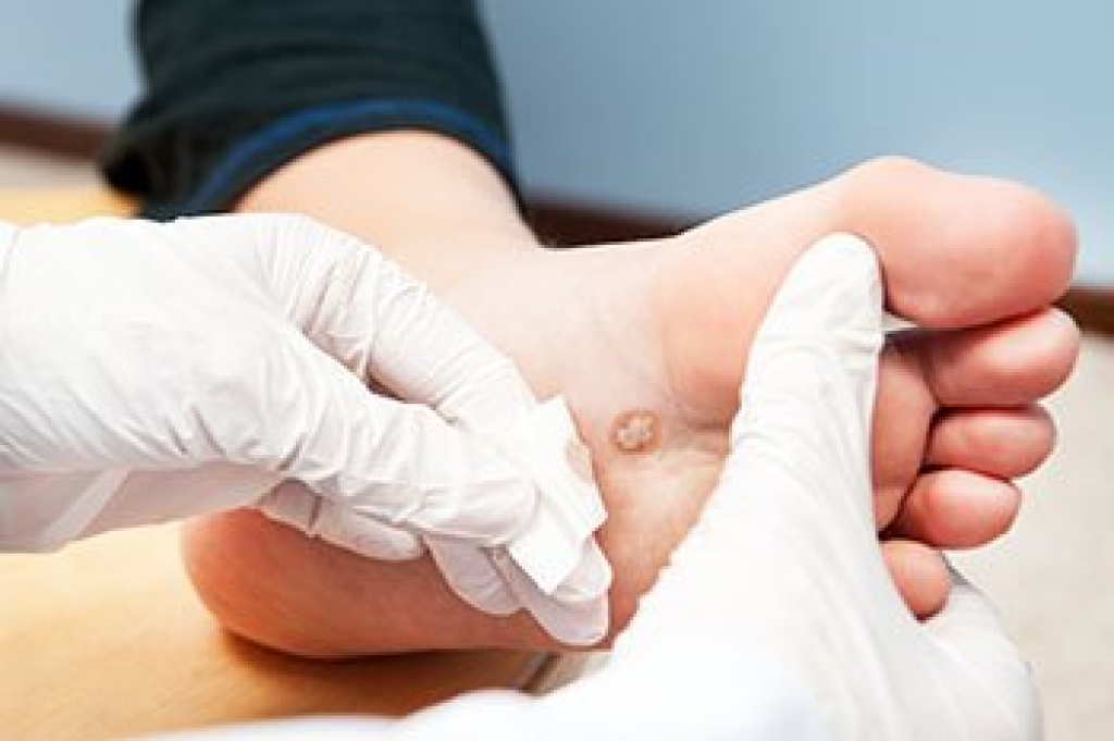 Painful Growth on Your Foot May Be a Plantar Wart