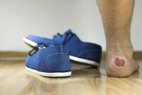 All About Foot Blisters