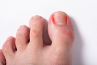Preventing Ingrown Toenails on the Trail